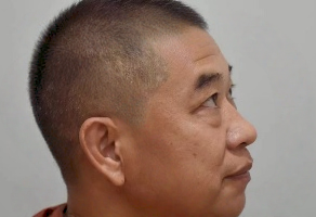 去眼袋手术