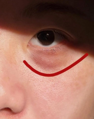 去眼袋手术
