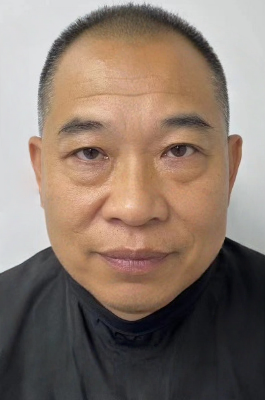 去眼袋手术