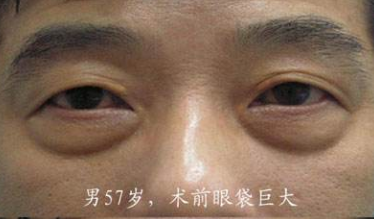 去眼袋手术