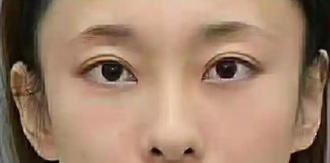 去眼袋手术