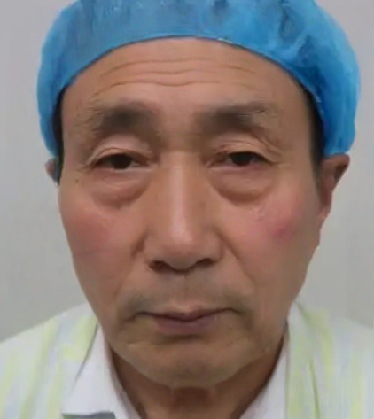 去眼袋手术