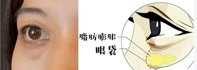 去眼袋手术