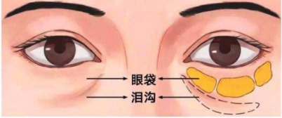 去眼袋手术