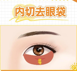 去眼袋手术
