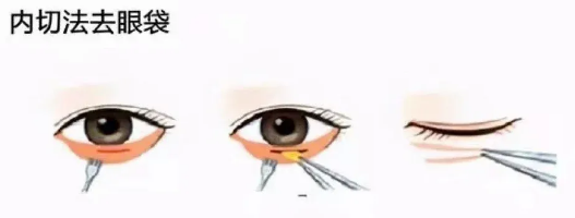 去眼袋手术