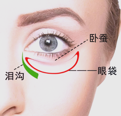 去眼袋手术