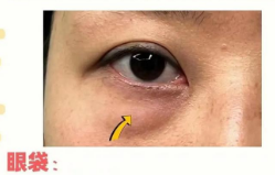 去眼袋手术