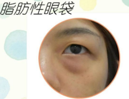 去眼袋手术