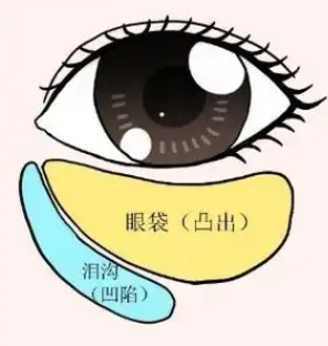 去眼袋手术