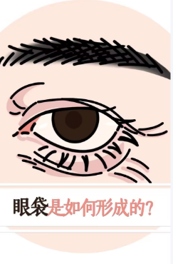去眼袋手术