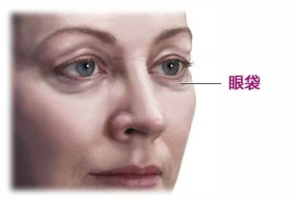 去眼袋手术