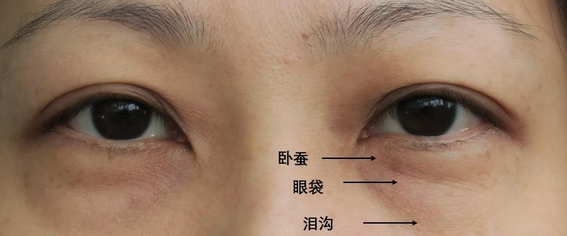 去眼袋手术