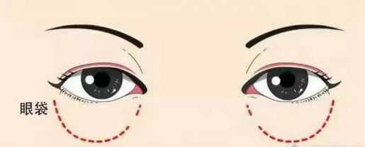 眼袋