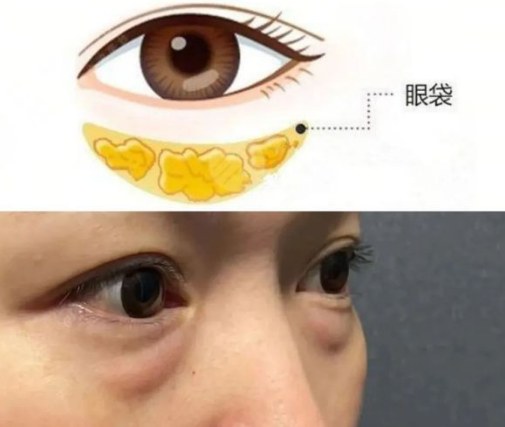 去眼袋手术