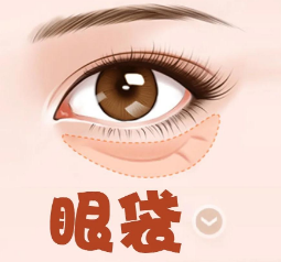 去眼袋手术