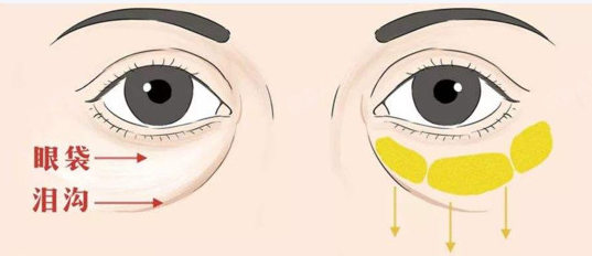 去眼袋手术