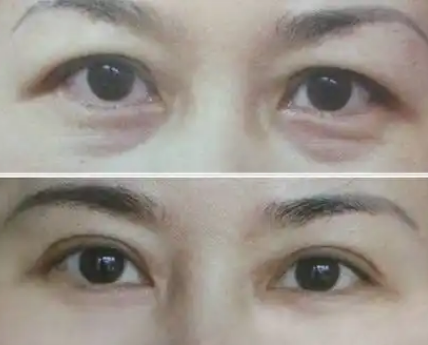 去眼袋手术