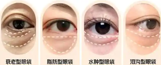 去眼袋手术