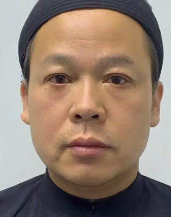 去眼袋手术