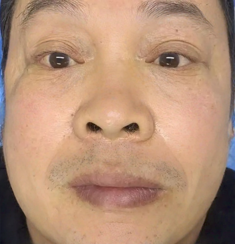 去眼袋手术