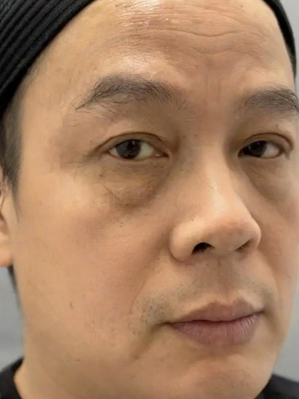 去眼袋手术