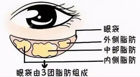 去眼袋手术