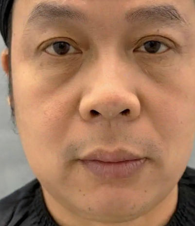 去眼袋手术