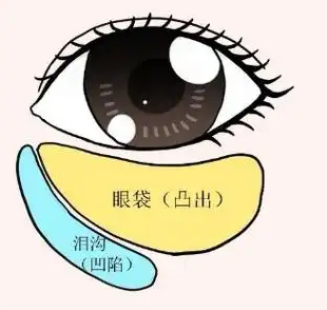 眼袋