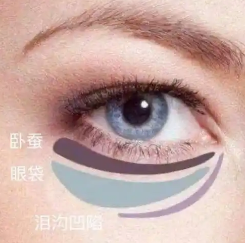 去眼袋手术