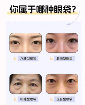 去眼袋手术