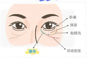 去眼袋手术