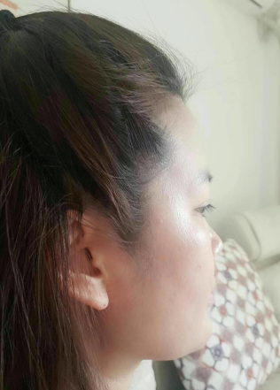 自体脂肪胶填充