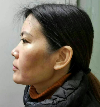 自体脂肪胶填充