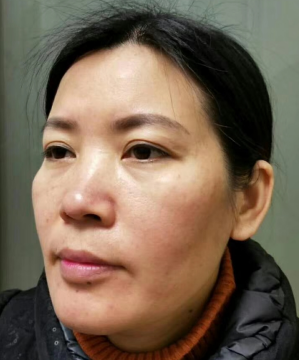 去眼袋手术