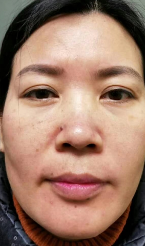 去眼袋手术