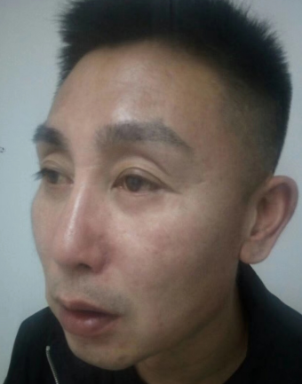 自体脂肪胶填充
