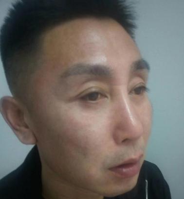 自体脂肪胶填充