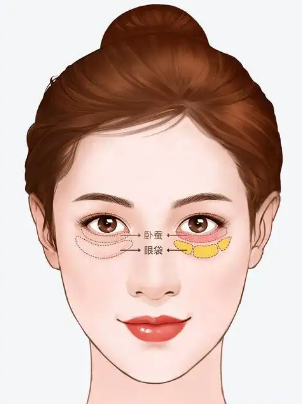 去眼袋手术