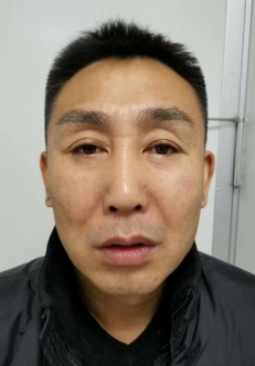 自体脂肪胶填充