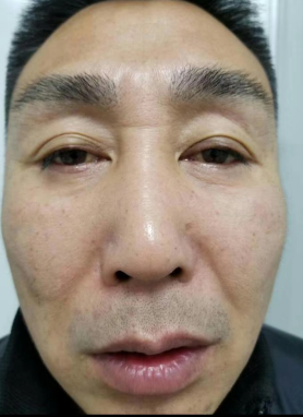 自体脂肪胶填充