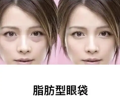 去眼袋手术