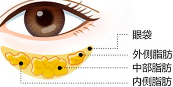 去眼袋手术