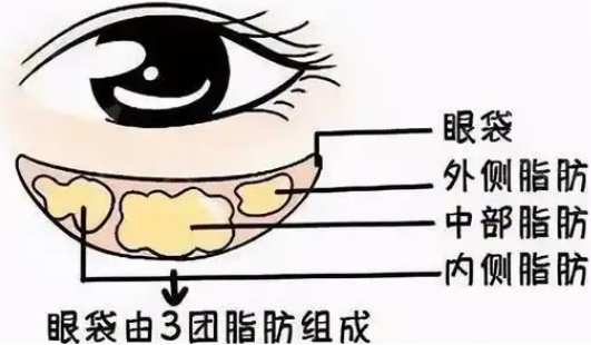 去眼袋手术