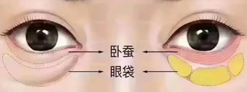 去眼袋手术