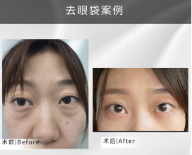 去眼袋手术