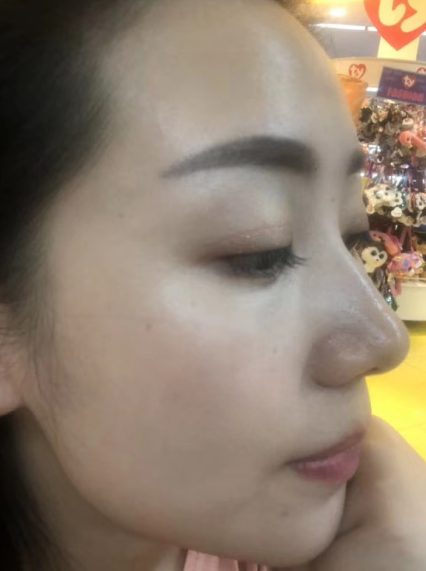 去眼袋手术
