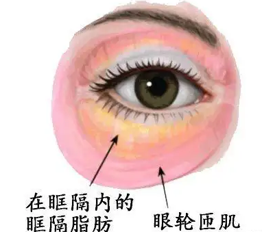 去眼袋手术