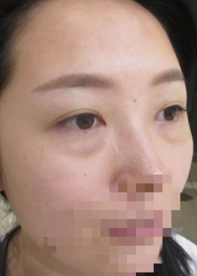 去眼袋手术