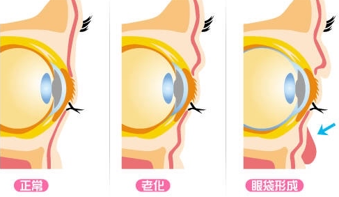 去眼袋手术